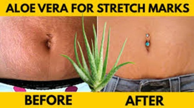 Image result for How Coffee and Aloe Vera Help Reduce Stretch Marks After Pregnancy ...