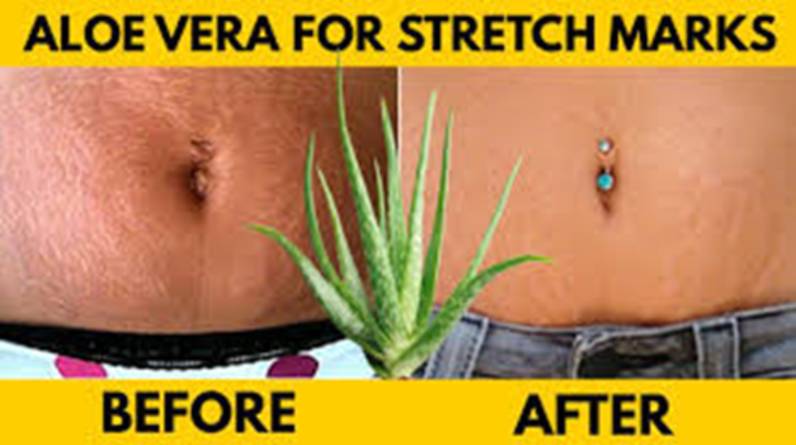 How Coffee and Aloe Vera Help Reduce Stretch Marks After Pregnancy